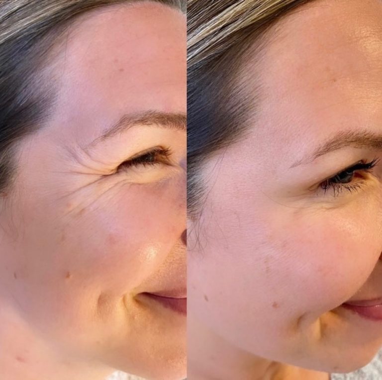 Before and after skincare wrinkle reduction
